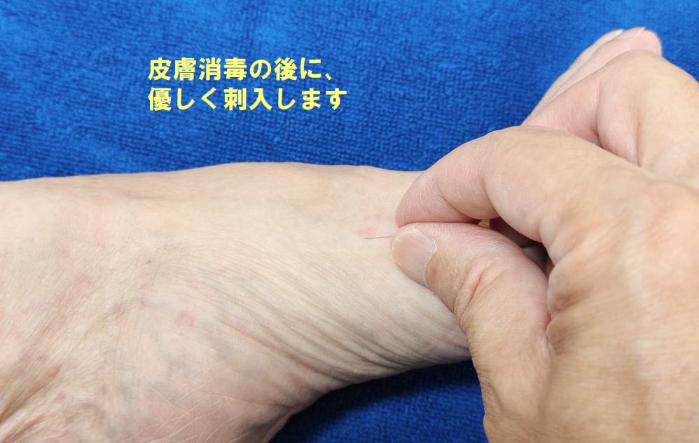 ツボの刺し方