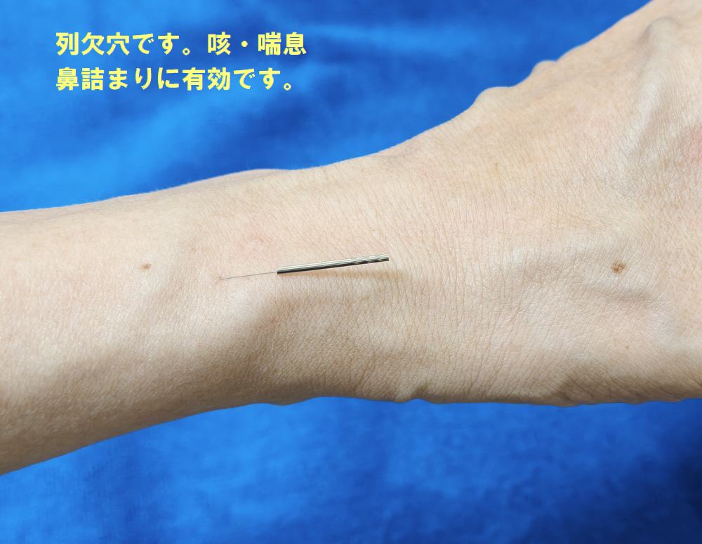 ツボの刺し方 列缺